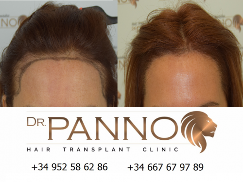 Foto Cl�nica de Trasplante Capilar Dr. Panno